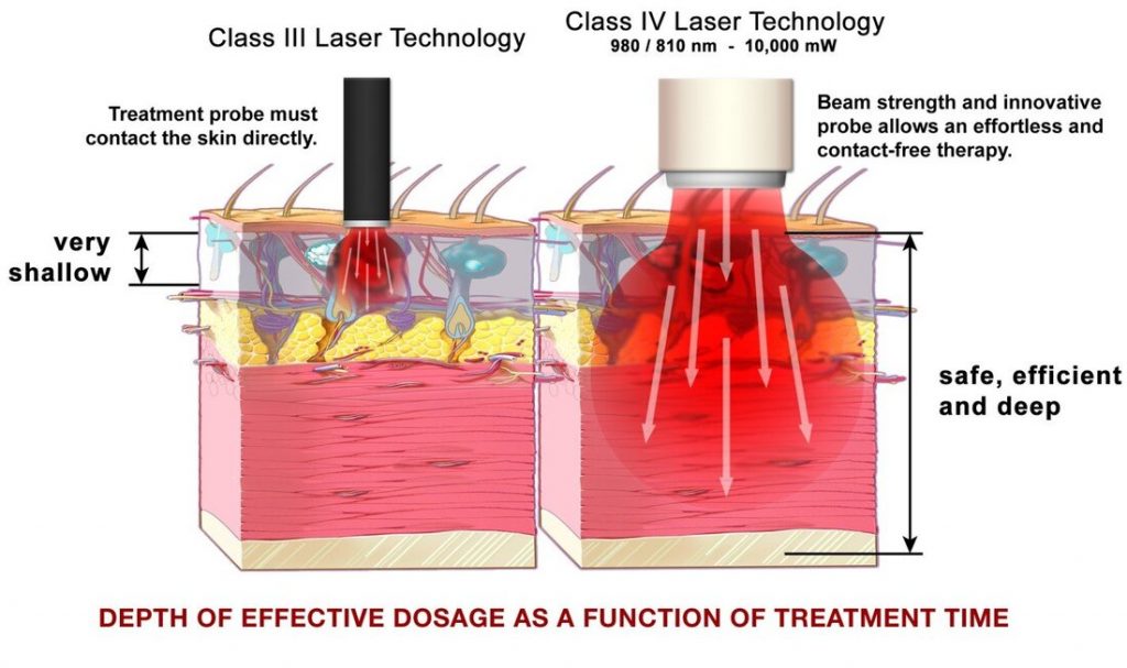 Class 4 laser therapy